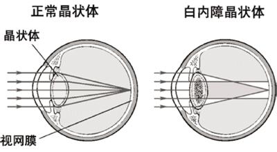 白內(nèi)障為何會(huì)影響視力