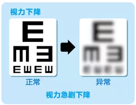 視網(wǎng)膜脫離啥癥狀？這張圖告訴你！