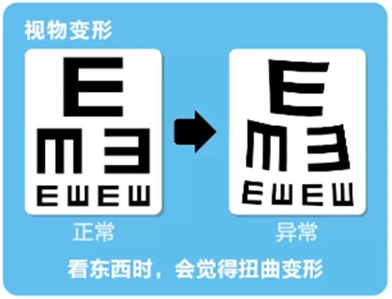 視網(wǎng)膜脫離啥癥狀？這張圖告訴你！