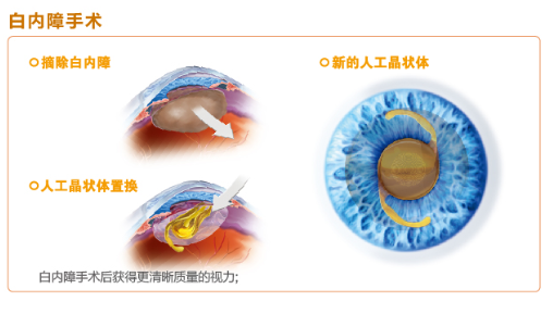 【圖文解答】如何有效改善白內(nèi)障
