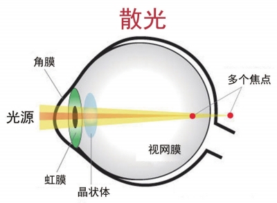 關(guān)于散光配鏡的兩大誤區(qū)