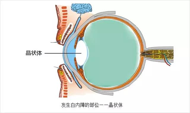 眼科主任告誡白內(nèi)障這幾大誤區(qū)，80%的老人上當(dāng)